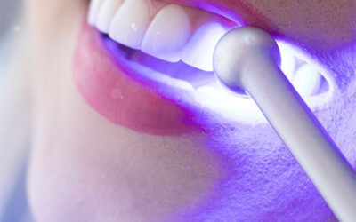¿Cuánto cuesta una limpieza dental en 2026? Precios reales, qué incluye y cuándo es necesaria