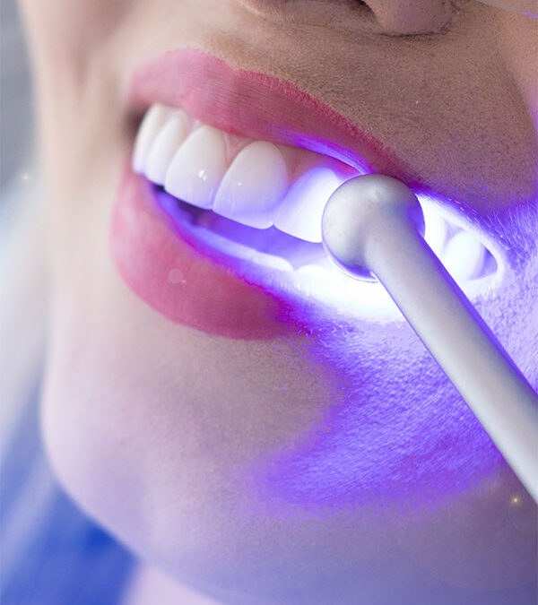 ¿Cuánto cuesta una limpieza dental en 2026? Precios reales, qué incluye y cuándo es necesaria