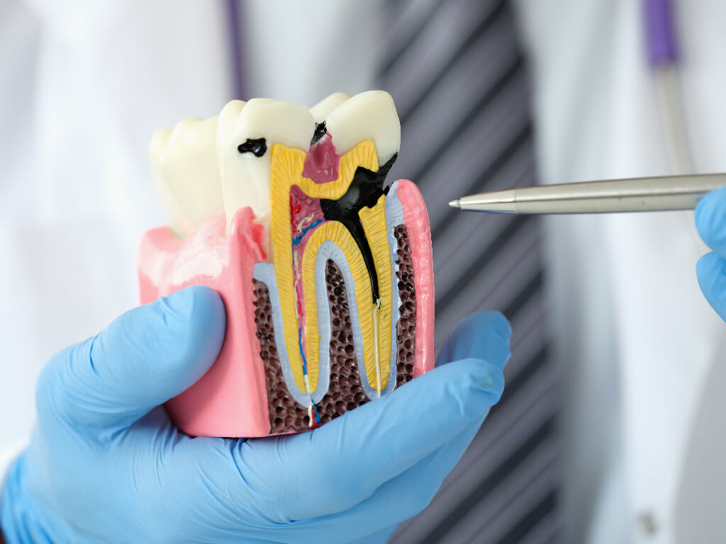 Fotografía de una muela de plástico con una caries