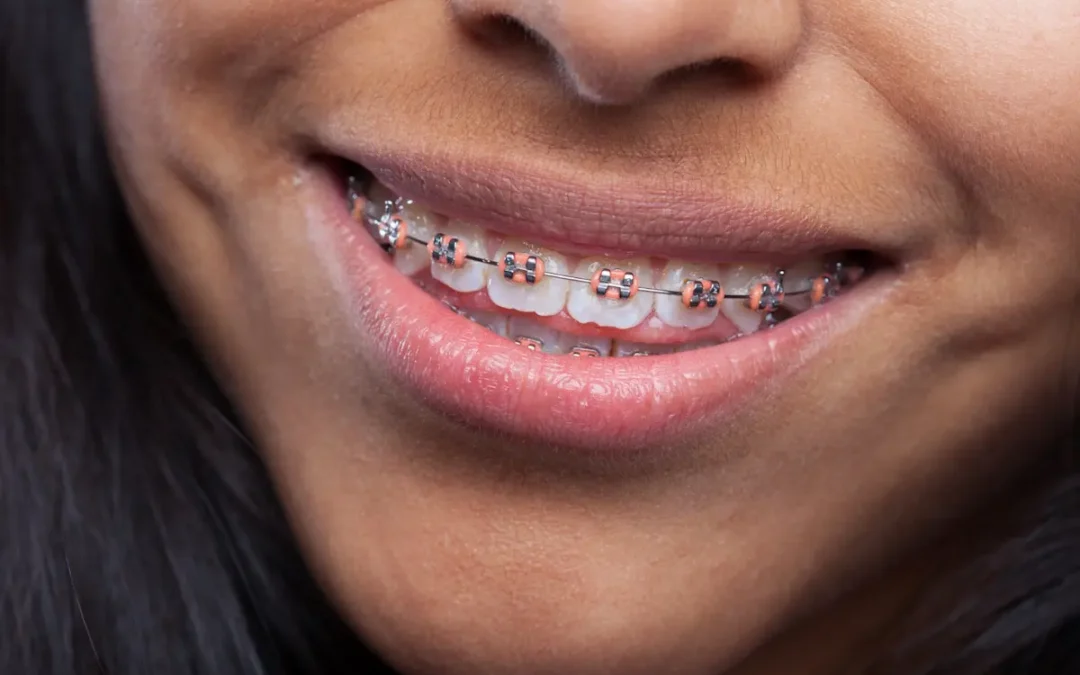 Brackets de colores: dale personalidad a tu sonrisa