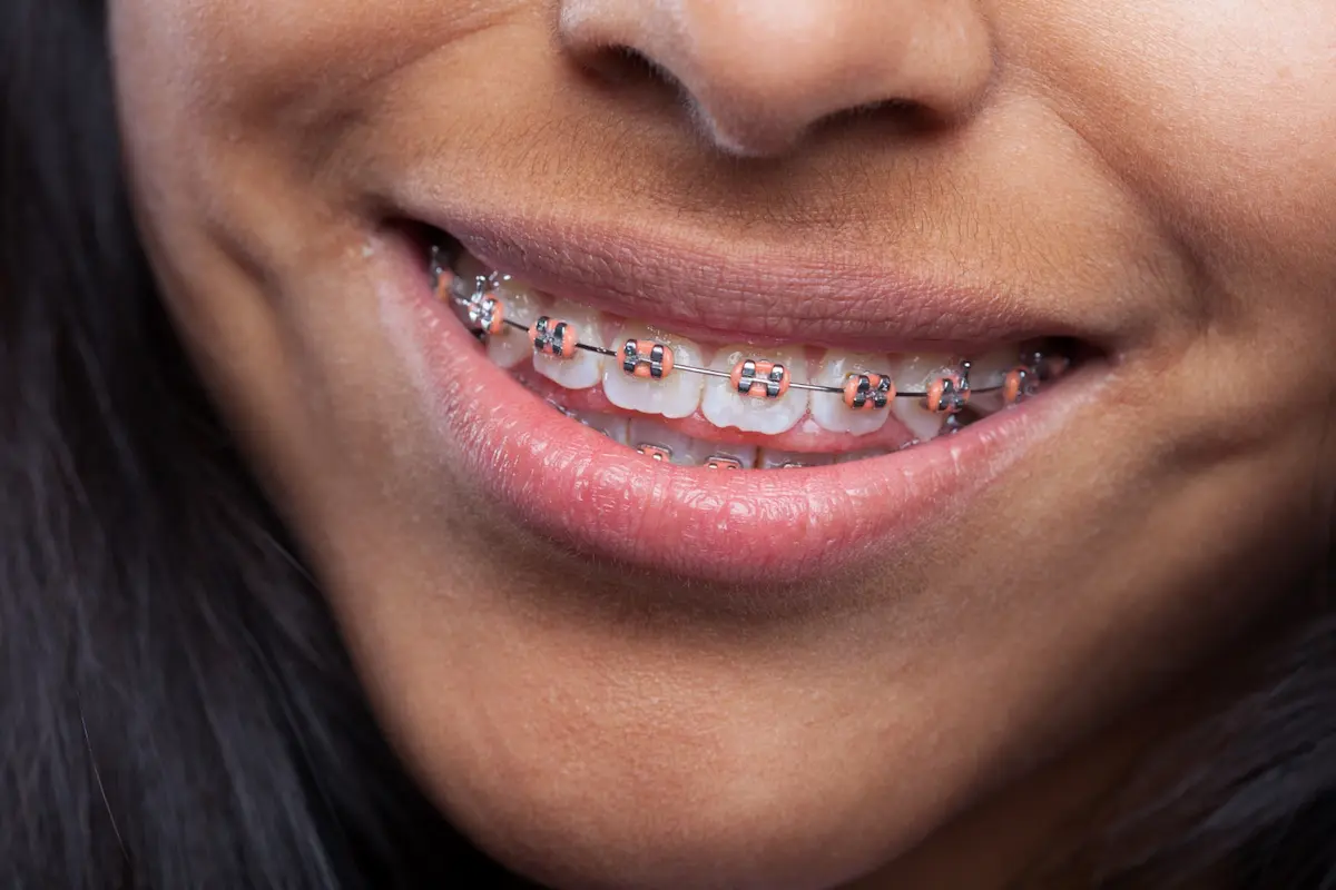 brackets de colores