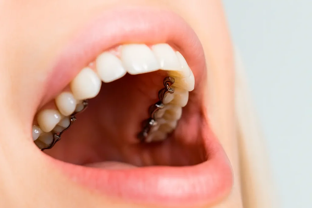 brackets linguales