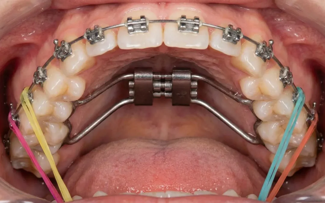¿Se puede poner ortodoncia con muelas del juicio?