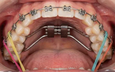 ¿Se puede poner ortodoncia con muelas del juicio?