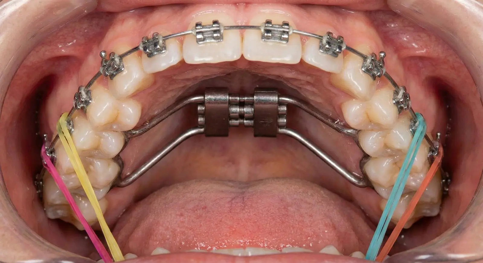 ortodoncia con muelas del juicio