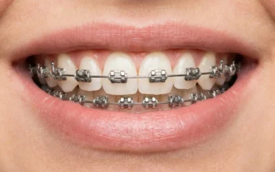 Brackets autoligables: qué son, qué aportan de verdad y cuándo merece la pena elegirlos